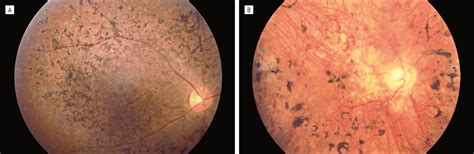 ABCA4 Gene Sequence Variations in Patients With Autosomal Recessive Cone-Rod Dystrophy ...