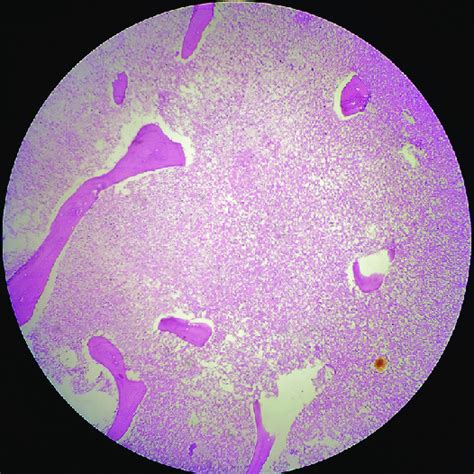 Bone marrow trephine biopsy specimen showing marrow necrosis... | Download Scientific Diagram