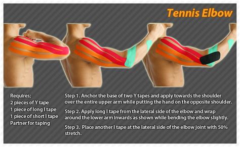 ares clinical taping - tennis elbow | Kinesiology, Kinesiology taping ...