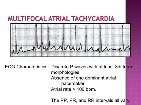 ECG: Multifocal Atrial Tachycardia