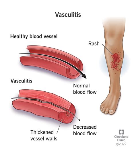 Allergy Vasculitis Weak Immune System Eos Level Outlet | varsana.com