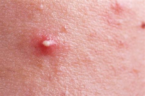 Never Pop a Pimple in the Danger Triangle | Reader's Digest