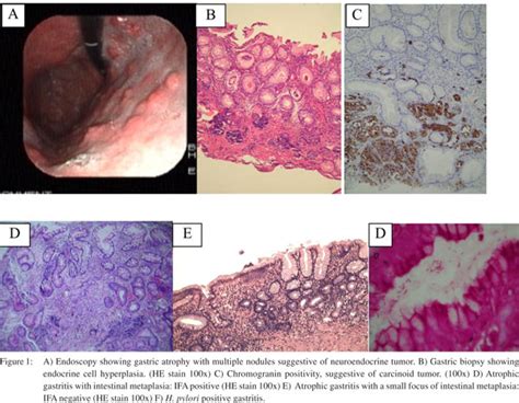 Atrophic Gastritis Histology