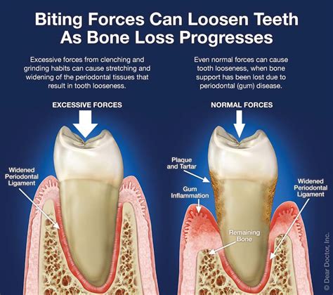 Occlusal therapy: why our bite is important – Britten Perio