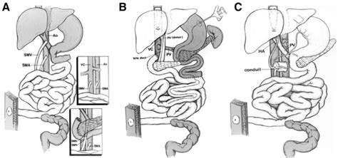 Types of intestinal allografts [17], a isolated intestinal allograft. b ...