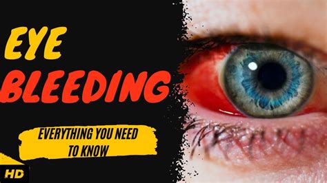 Eye Bleeding: Everything You Need To Know - YouTube