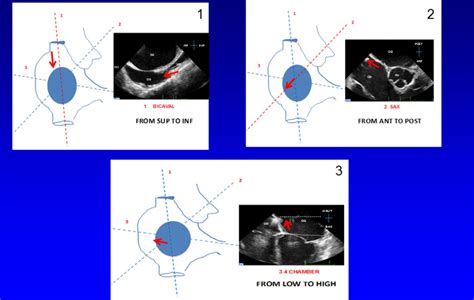 Transseptal puncture for structural heart intervention: an old technique with new indications ...