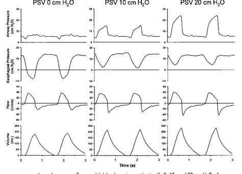 Ventilator Waveforms