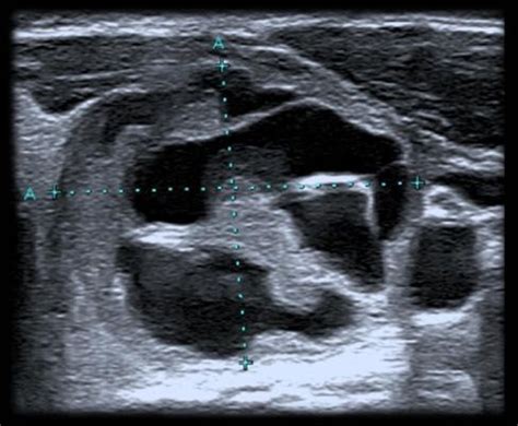 Nodule Thyroïdien: Classification EU-TIRADS 2017 - Radiologues Associes