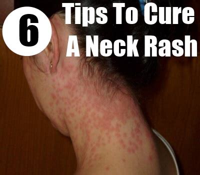 How To Cure A Neck Rash - Home Remedies For Neck Rashes | Natural Home ...