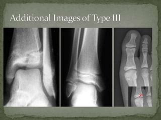 Salter Harris Type 3 Fracture