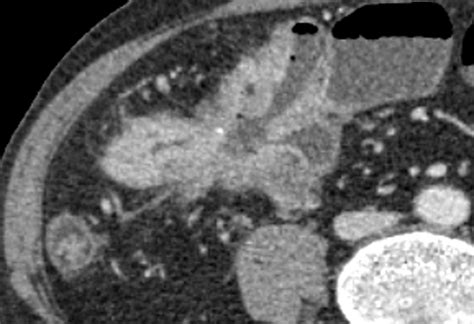 Crohn disease: A -an axial computed tomography scan showing an... | Download Scientific Diagram