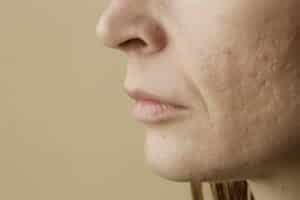 Pockmarks: What are these marks on face? Removal and Prevention