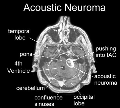 Acoustic Neuroma MRI Images