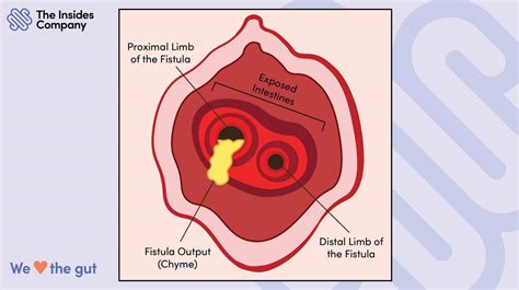 What is an Enterocutaneous Fistula and Enteroatmospheric Fistula?