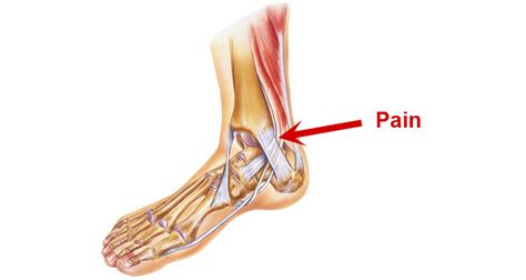 Tibialis Posterior Tendonitis (Tendinopathy) - Sportsinjuryclinic.net