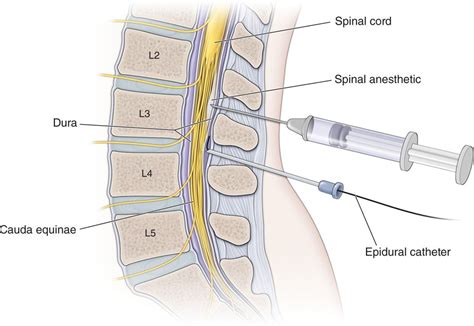 Intrathecal Drug Delivery Trialing Procedures | Anesthesia Key