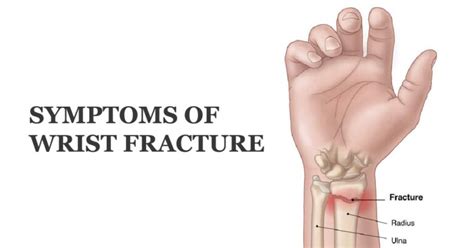 Symptoms of Wrist Fracture – Welcome to SYS MEDTECH INTERNATIONAL PRIVATE LIMITED