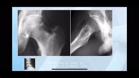 Radiological Diagnosis of Bone Lesions made simple - YouTube