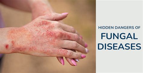 Silent Threats You Should Know About Fungal Diseases In Humans | MrMed