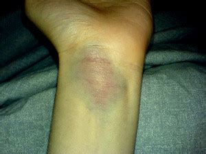 wrist bruise | Flickr - Photo Sharing!