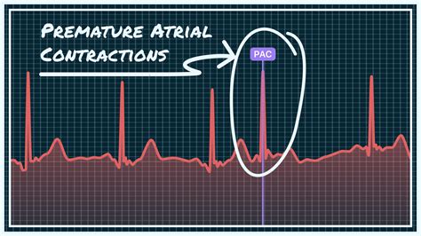 Premature Atrial Contractions