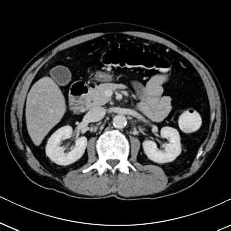 File:Chronic appendicitis complicated by appendicular abscess, pylephlebitis and liver abscess ...