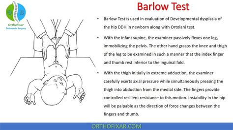 Developmental Dysplasia Of The Hip, Hip Dislocation, Greater Trochanter, Musculoskeletal System ...