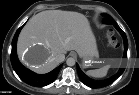 Calcified Hydatid Cyst In The Liver Seen On Ct Image High-Res Stock ...