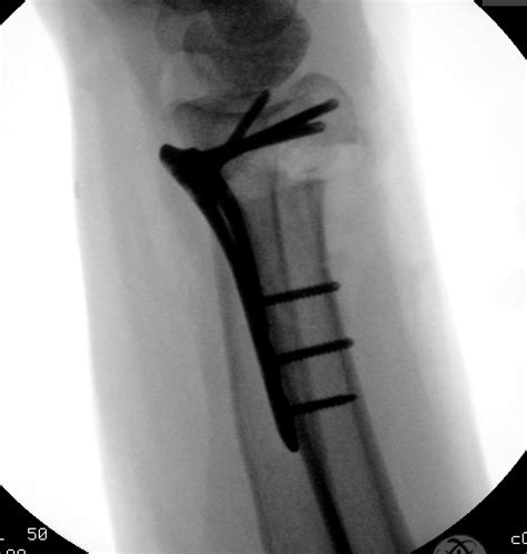 Fracture-Osteotomy distal radius