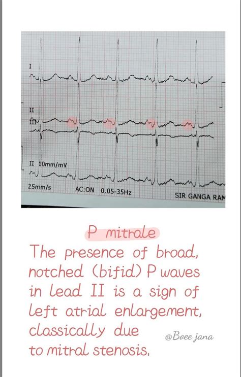 P mitrale in 2022 | Ecg interpretation, Stenosis, Anatomy and physiology