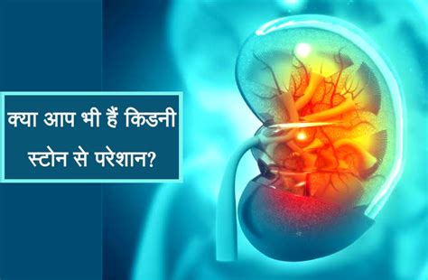 Kidney Stone Prevention and effective treatment in hindi | किडनी स्टोन के दर्द से हैं परेशान, तो ...