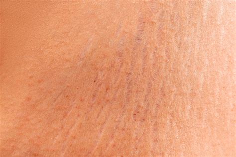 Stretch marks on the skin, wrinkles,obeseness - Creative Commons Bilder