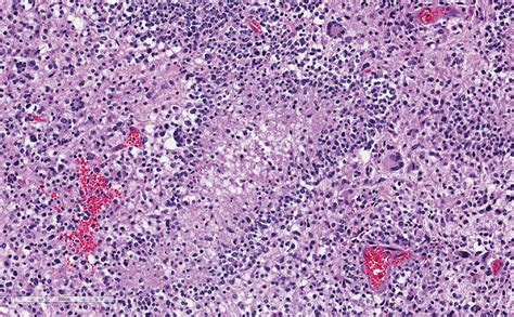 Neuropathology — Loyola Pathology