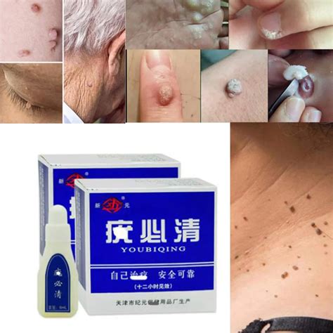 Mole & Skin Tag Repair Solution Painless Mole Skin Dark Spot Repair Face Wart Tag Freckle Repair ...