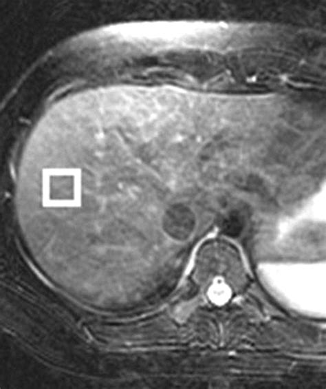 MR Spectroscopy of the Liver: Principles and Clinical Applications ...