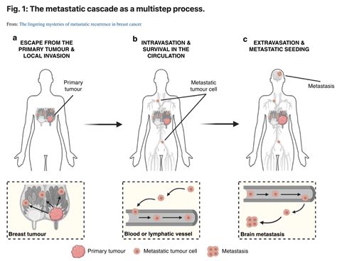 'The lingering mysteries of metastatic recurrence in breast cancer' in ...