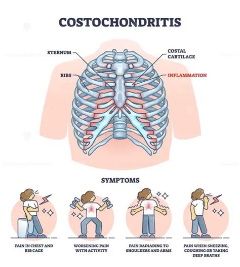 Costochondritis as chest wall pain or costosternal syndrome outline ...