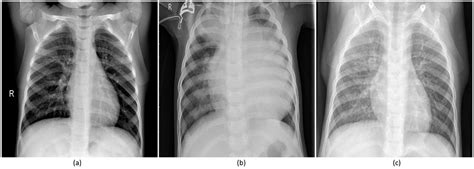 Pneumonia Healthy Lungs Xray - Goimages Urban