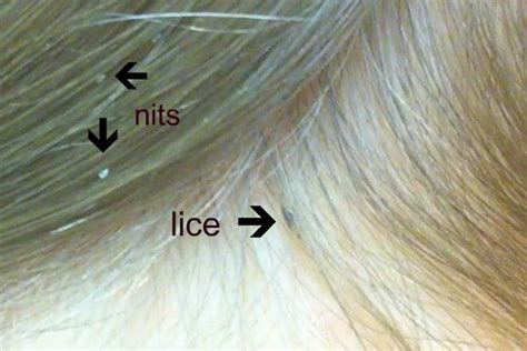 Head Lice And Nits In Children: The Symptoms And Treatment - Netmums