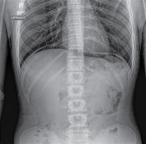 Abdominal radiography | Radiology Key