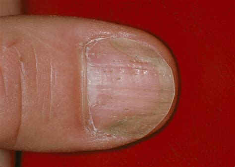 Nail psoriasis or fungus?: Differences, symptoms, and outlook