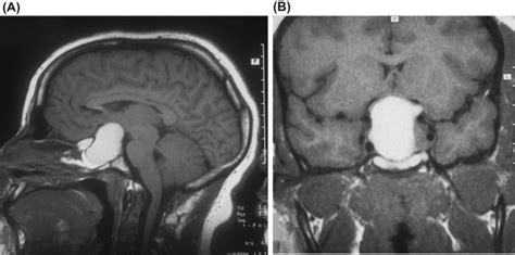 Pituitary Apoplexy | Anesthesia Key