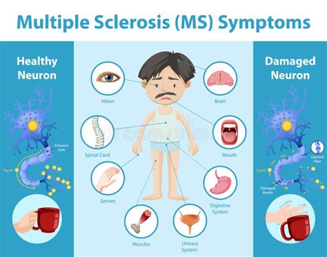 Multiple Sclerosis Symptoms Icon Stock Illustrations – 38 Multiple Sclerosis Symptoms Icon Stock ...