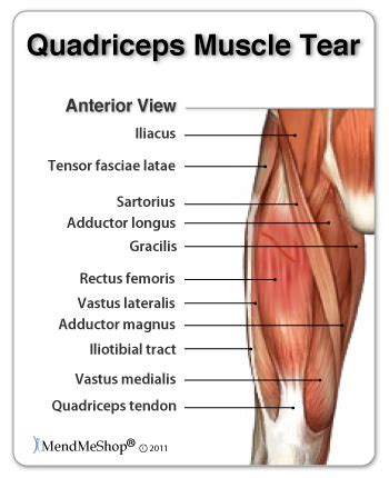 Hip Muscle Strain-Tear Treatment