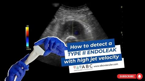 How to detect an endoleak: type II endoleak with high jet velocity ...