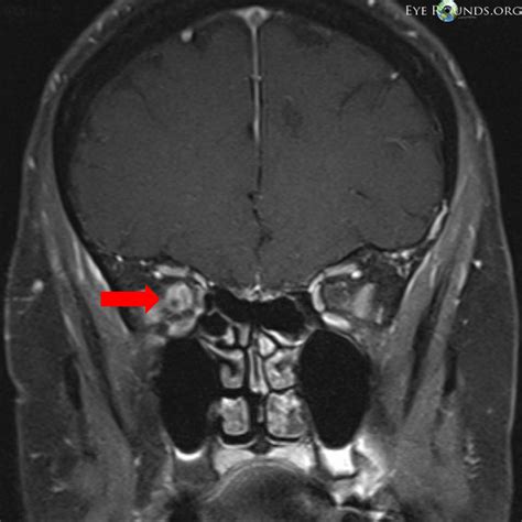 Optic nerve sheath meningioma