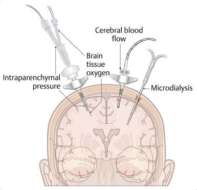 13 Placement of External Ventricular Drain/Placement of ...