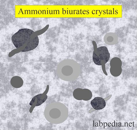 Urine Crystals (Crystalluria) - Labpedia.net