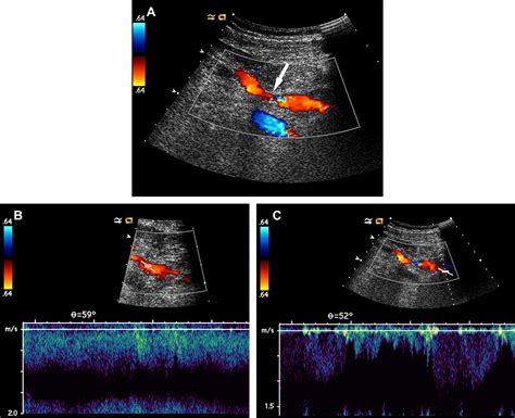 Upper Extremity Venous Doppler Ultrasound - Radiologic Clinics